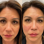 Cerotti oculari in idrogel di peptidi e collagene