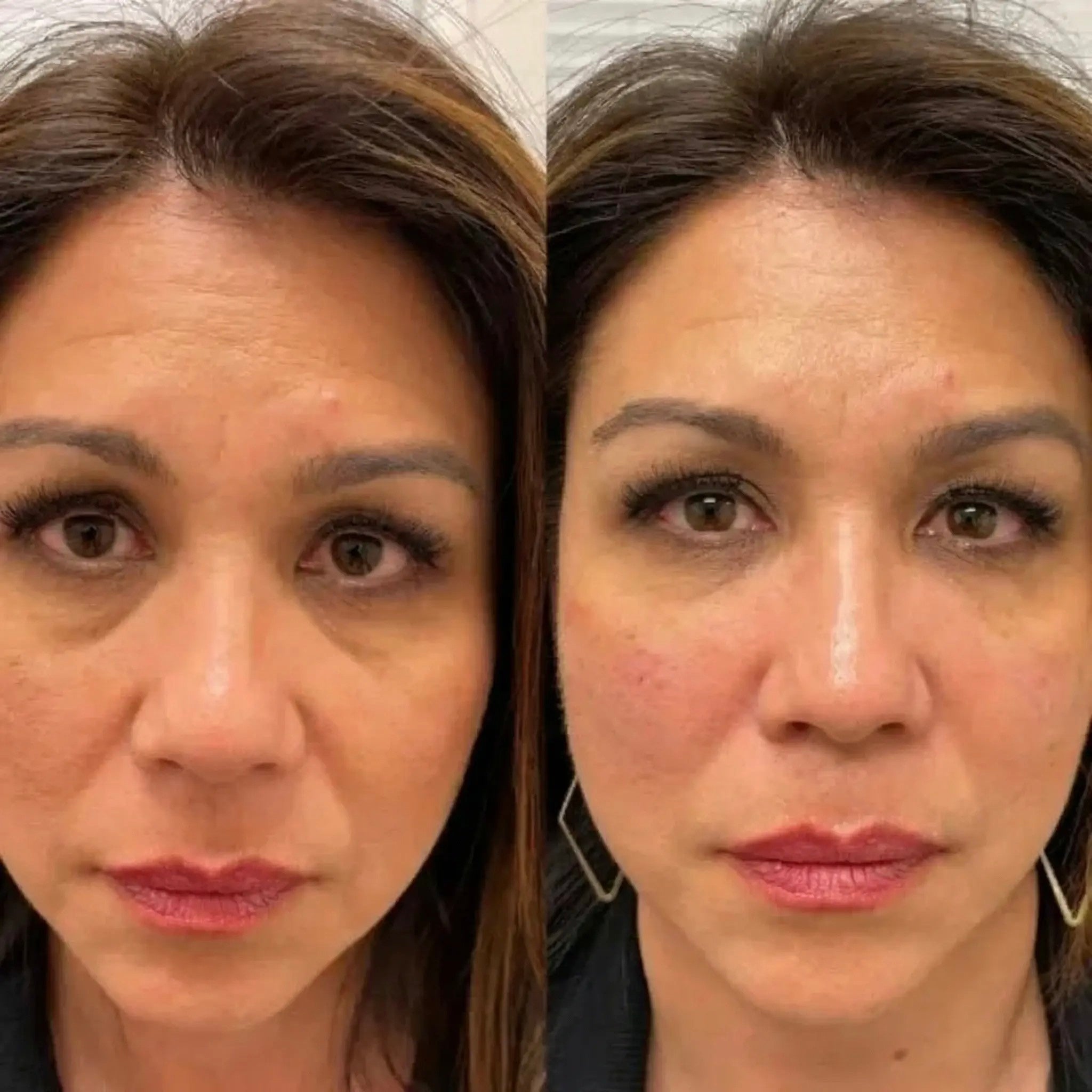 Cerotti oculari in idrogel di peptidi e collagene